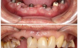 珠江台公益种牙