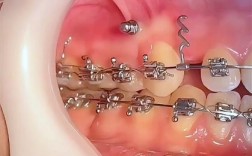 正畸打骨钉内收效果