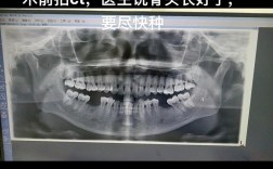 种牙后骨密度低