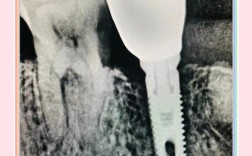 植牙后 看不见种植体