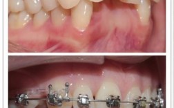 康圆口腔矫正牙齿效果如何？性价比高吗？