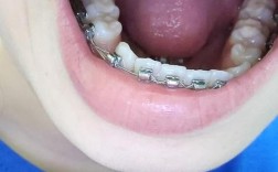 矫正牙齿垫高掉了