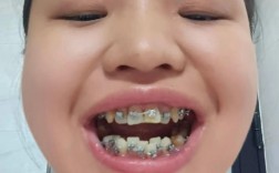 牙齿矫正钢丝越换越粗