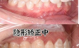矫正牙齿效果最好？不同方式效果如何，哪种最适合你的牙齿？