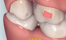 自己在家粘正畸附件