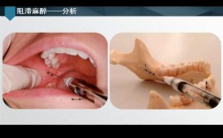 口腔各牙麻醉方法