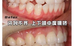 牙齿矫正后咬合不齐，是矫正效果不好吗？