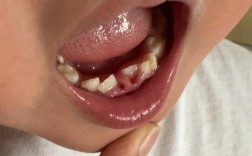 牙医种牙没长出来？是什么原因导致的？