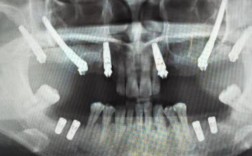 离上颌骨近种牙风险大吗？如何安全种植不伤骨？