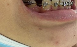 22岁矫正牙齿晚吗？现在矫正还来得及吗？