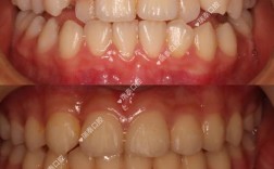 正畸后更加露牙龈
