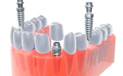 福州晶特尔口腔种牙效果如何？技术靠谱吗？价格贵不贵？