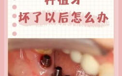 牙周不好不能种牙？背后原因究竟是什么