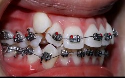 广州番禺正畸牙齿纠正，效果和价格怎么样？