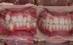 正畸牙弓轻度拥挤需要积极进行正畸干预吗？