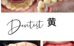 牙周刮治后正畸