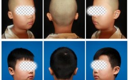 中年人耳朵畸形正畸可行吗？效果如何？