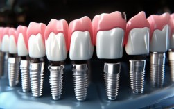 2025最新All-on4种植牙修复步骤有几步？