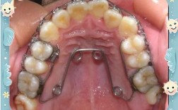 正畸四眼圈簧图片具体展示什么？