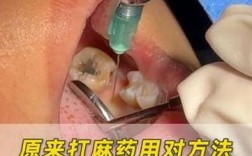 种牙打的麻药是什么？有哪几种常用类型？