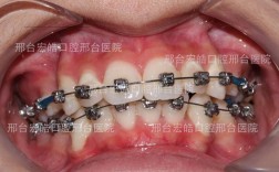 牙齿畸形不矫正，会引发哪些健康隐患？