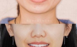 不拔牙矫正牙齿，脸型真的能改变吗？