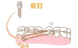 种植钉推磨牙向后方法