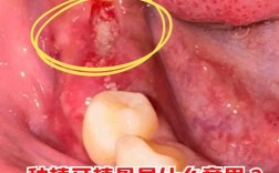 植牙可以植在颧骨上吗