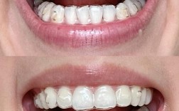 北京隐形牙齿矫正效果如何？价格贵不贵？哪家靠谱？