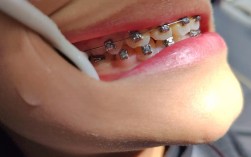 二十几岁矫正牙齿，年龄偏大会影响效果与周期吗？