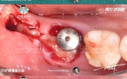 正畸种植钉取出