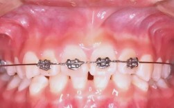 口腔正畸2 4矫治技术PPT