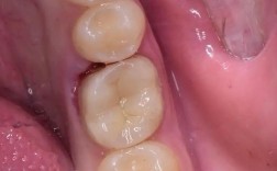 树脂充填后如何正确调合？关键步骤与操作要点是什么？