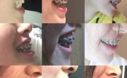 正畸下颌垫佩戴为何如此辛苦？体验者坦言有哪些难熬之处？