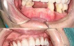 拔牙矫正后牙齿松动，是正常现象还是异常信号？