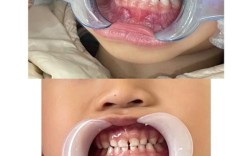 宁波儿童牙齿矫正，几岁开始矫正效果最佳？