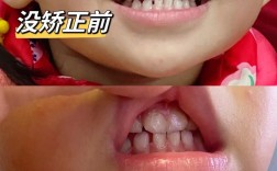 口腔儿童反颌正畸