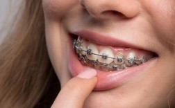 牙齿矫正效果能维持多久？关键注意事项