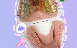 固定矫正期内扩弓方法