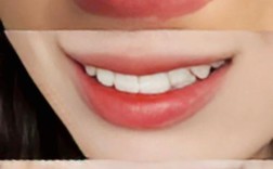 三十几岁矫正牙齿来得及吗？