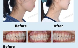 牙齿矫正对嘴型改变的影响有多大？效果显著吗？