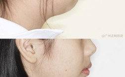 下巴短口腔正畸