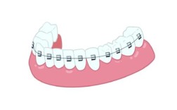 牙齿矫正后，为何反弹总防不住？