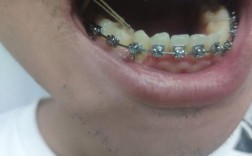 22岁矫正牙齿，这个年龄还来得及吗？效果怎么样？
