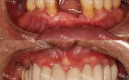 矫正牙齿前修复