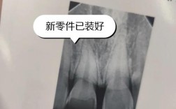 小孩门牙断裂后，有哪些修复方法适合不同情况？