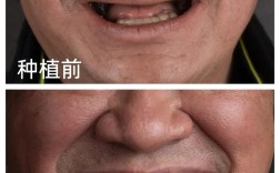 多个牙齿缺失种牙，如何选择更安心的方案？