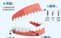 种牙有哪几种种植体
