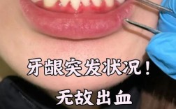 正畸牙龈出血严重