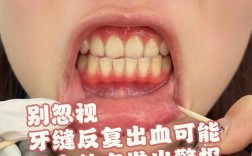 正畸期间牙龈红肿出血